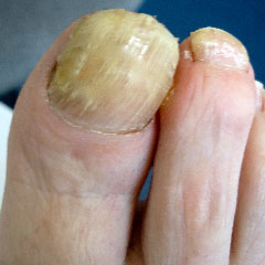 Fungal nail