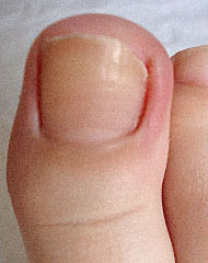 Ingrown toenail